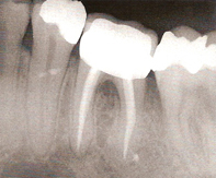 endodoncie