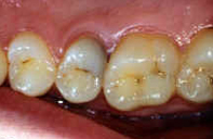 zubní kaz
