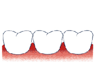 zubní korunka